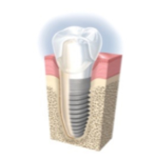インプラント