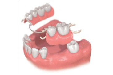 部分入れ歯