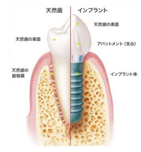 インプラント